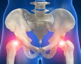 causes of osteoarthritis of the hip joint