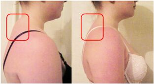 Formation of a muscle cushion in cervical osteochondrosis