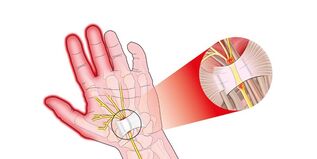 pain in the joints of the fingers with rhizarthrosis