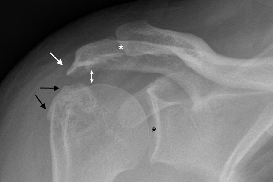 arthrosis of the shoulder joint on X-rays