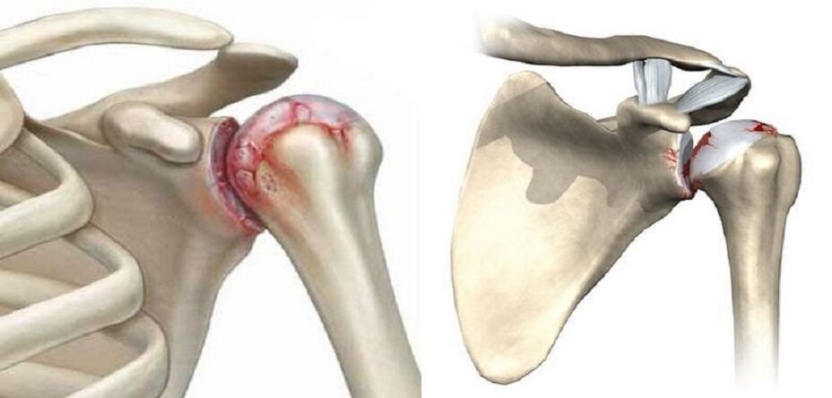 destruction of the shoulder joint with arthrosis