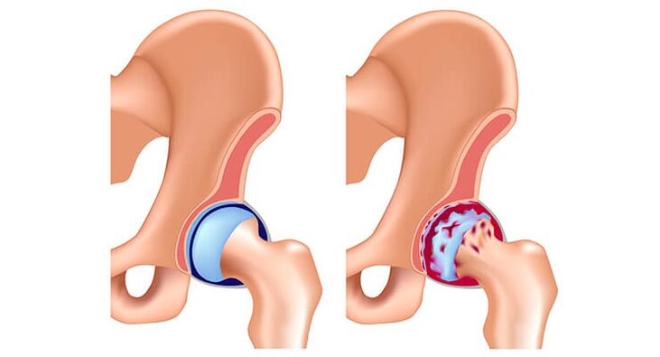 healthy and arthritic hip joint